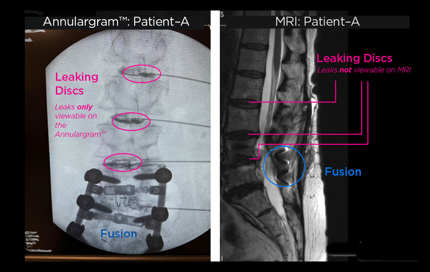 An Annulargram uses live X-ray contrast to identify disc tears an MRI can miss.