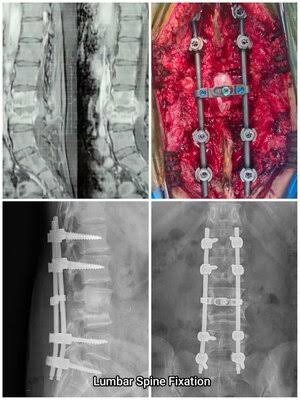 Lumbar spine fixation: MRI, open-back surgery with rods and screws, and X-rays. Discseel Procedure is not open fusion.